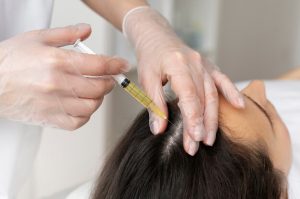 مزوتراپی در درمان ریزش مو
