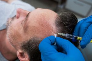 نحوه تزریق مزوتراپی در درمان ریزش مو