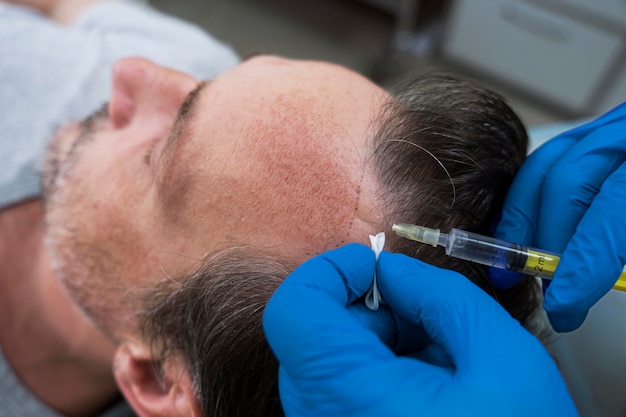 چگونه با مزوتراپی ریزش مو را درمان می کنیم؟❤️