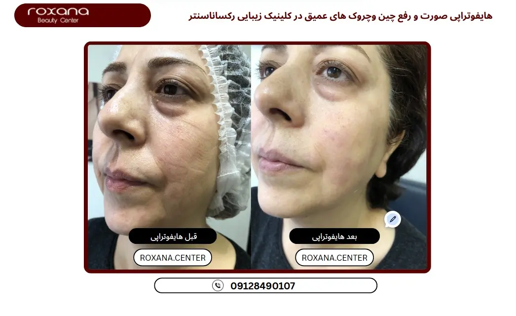 هایفوتراپی برای لک صورت