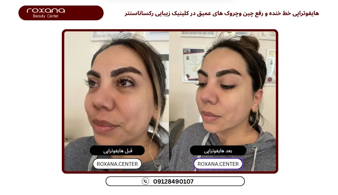 بهترین مرکز هایفوتراپی تهران