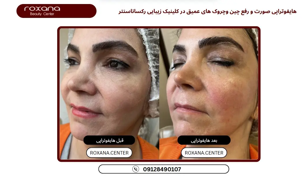 بهترین دکتر هایفوتراپی گردن در تهران