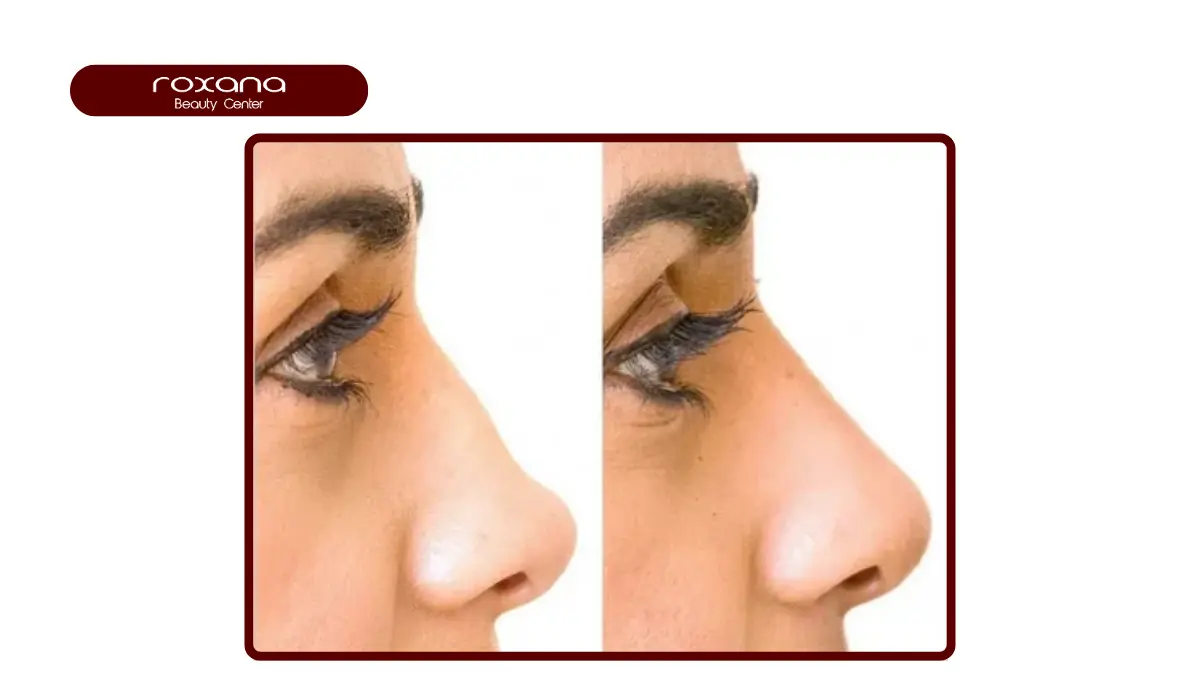 هایفوتراپی بینی