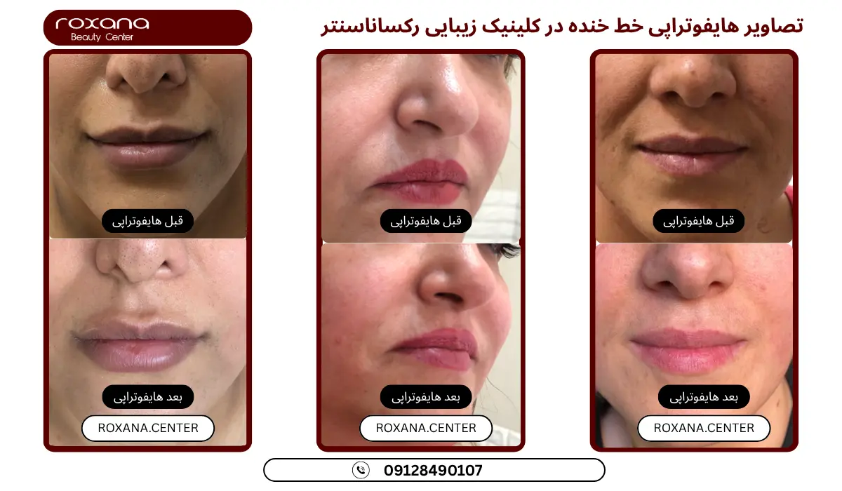 تصاویر قبل و بعد از هایفوتراپی صورت رکساناسنتر