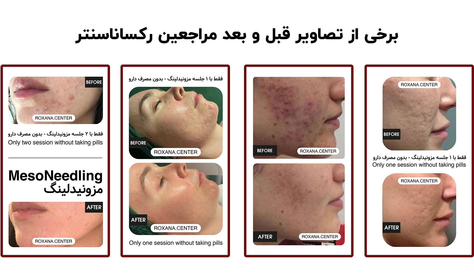 مزونیدلینگ | رکساناسنتر