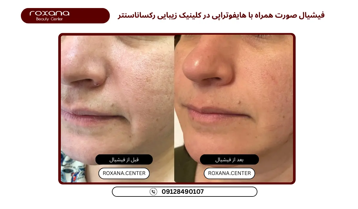 بهترین مرکز فیشیال پوست تهران