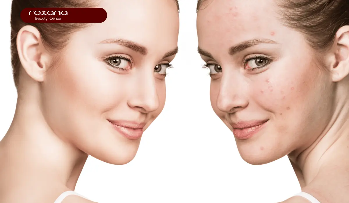 فیشیال پوست چرب