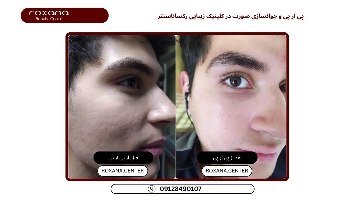 بهترین مرکز پی آر پی در تهران