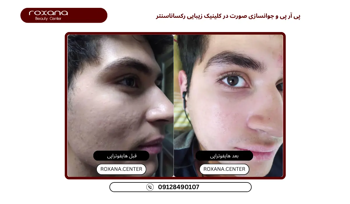 بهترین مرکز پی آر پی در تهران