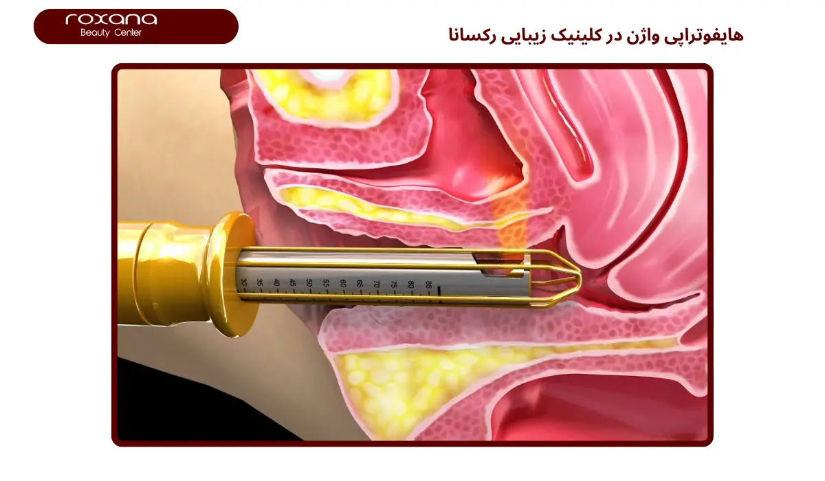 هایفوتراپی واژن