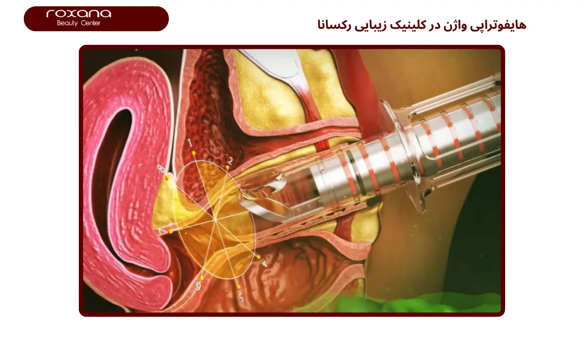 هایفو واژینال در تهران