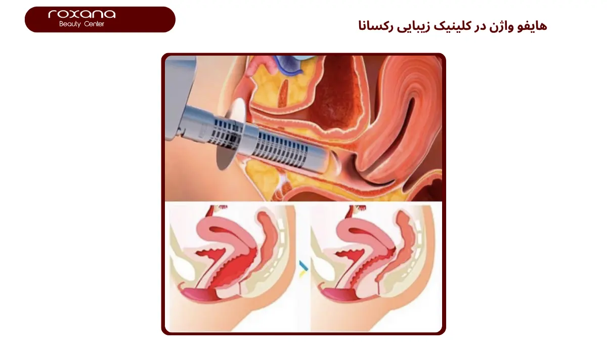 هایفو واژن در تهران