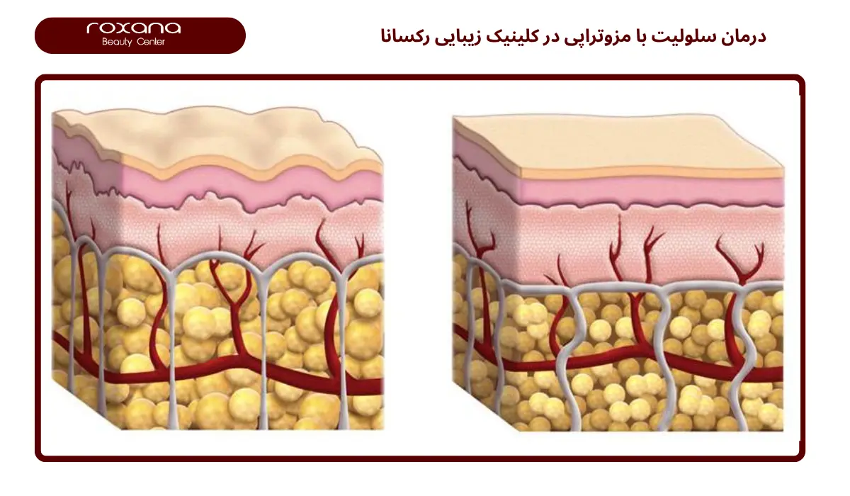 درمان سلولیت با مزوتراپی