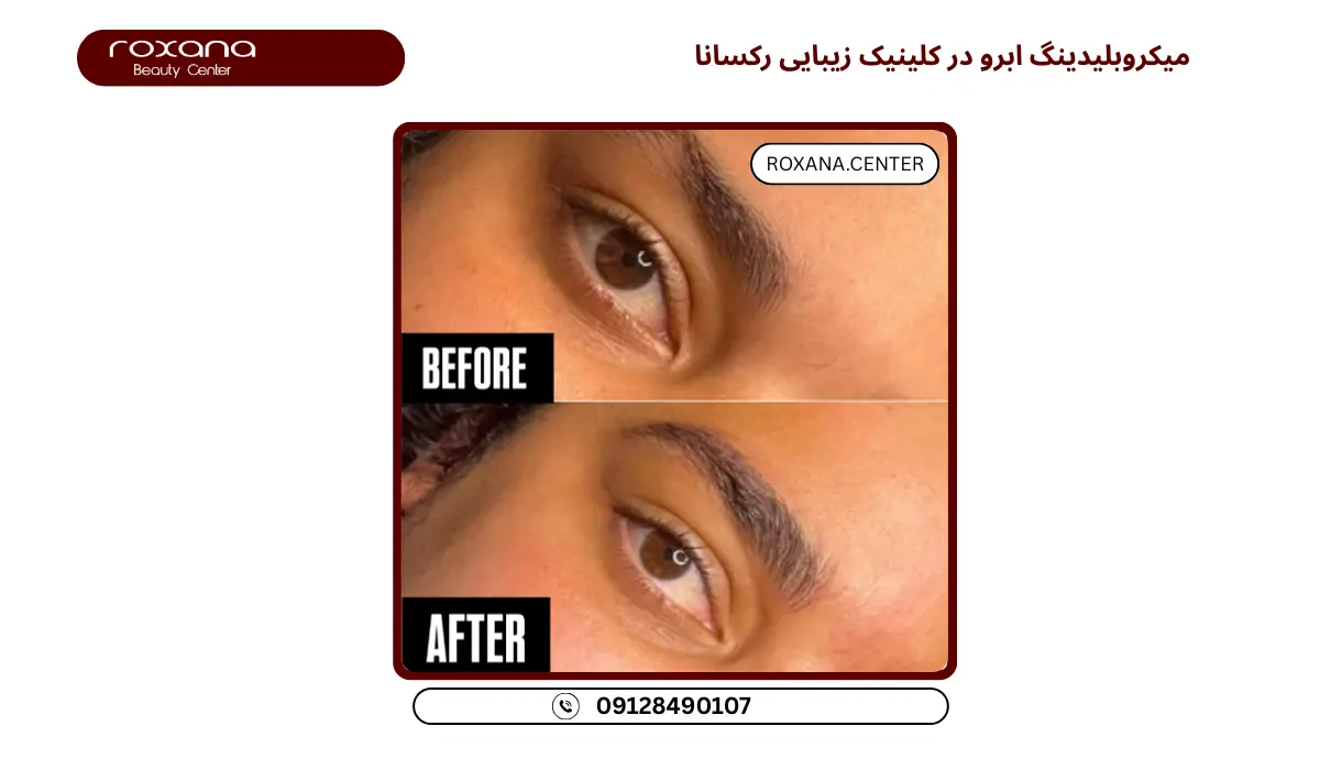 مرکز میکروبلیدینگ تهران
