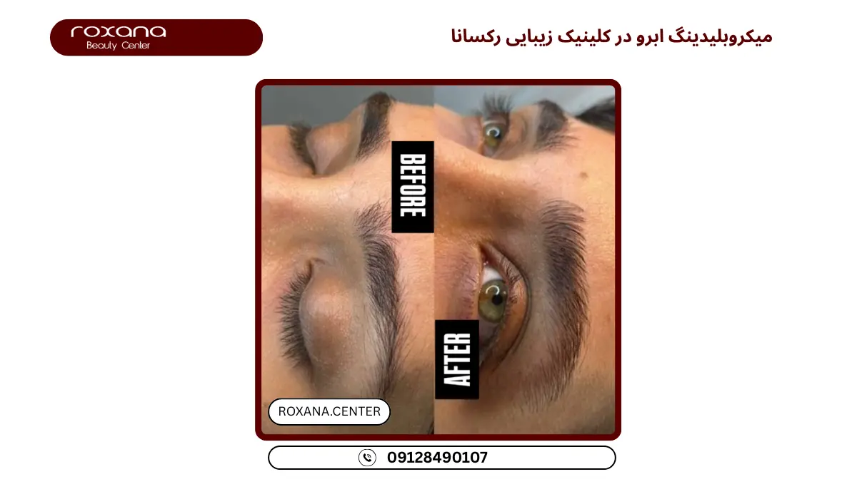 مرکز میکروبلیدینگ ابرو تهران