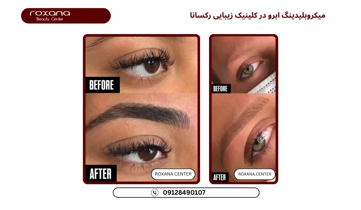 بهترین مرکز میکروبلیدینگ ابرو تهران