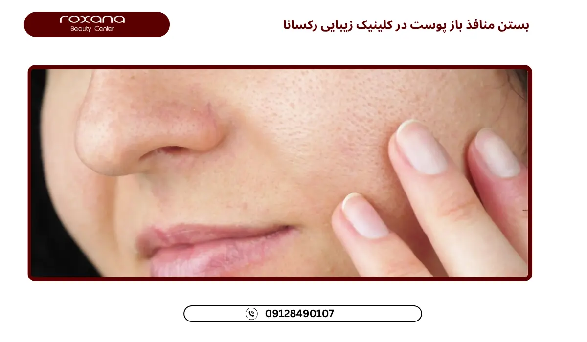 بستن منافذ باز پوست