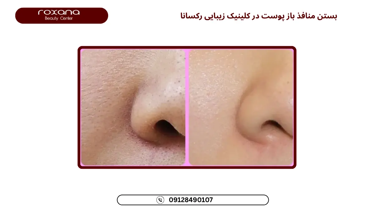 لایه برداری پوست و جوانسازی عمیق صورت، بستن منافذ پوست صورت